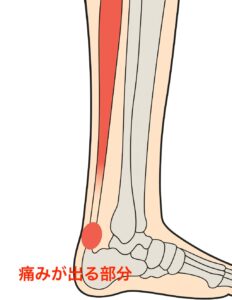 アキレス腱が痛い部分