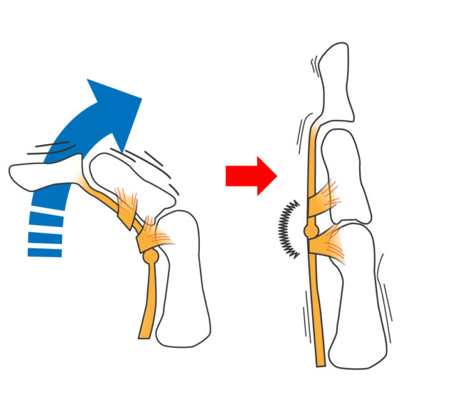 動画あり 中指がばね指 痛みを改善する効果的なテーピング方法 西宮 宝塚で根本改善の整体ならひこばえ整骨院へ