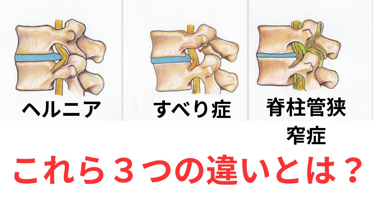 すべり症と脊柱管狭窄症・腰椎ヘルニアの違いとは？｜症状・原因・治療の見分け方