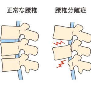 分離症を表したイラスト
