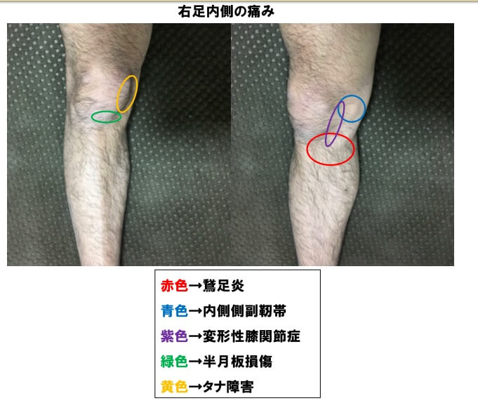 歩く時 階段の昇降時に膝の内側が痛い原因 西宮 宝塚で根本改善の整体ならひこばえ整骨院へ