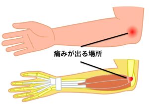 ゴルフ肘の痛み場所を示している部分