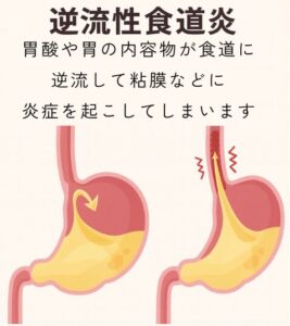 逆流性食道炎を示した図
