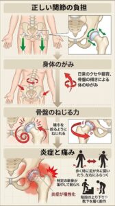 変形性股関節症が体の捩れで症状が悪化する理由