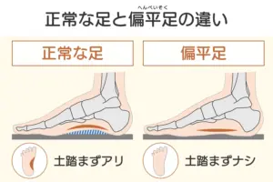 扁平足と通常の足を比較する図