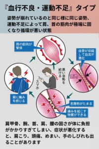 肩こりの原因血行不良、運動不足タイプ