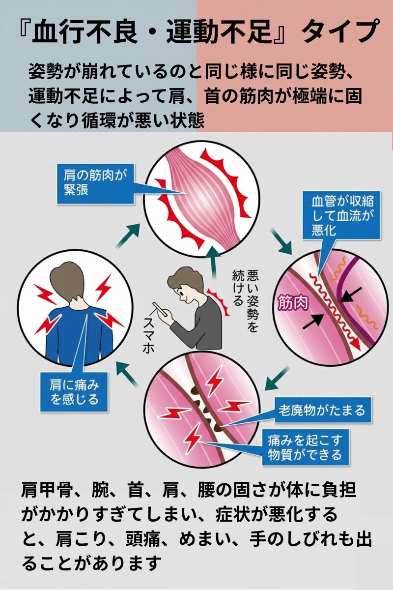 肩こりの原因血行不良、運動不足タイプ
