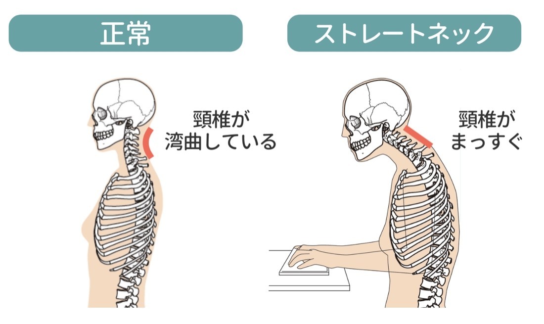 頚椎 症 でも できる 仕事