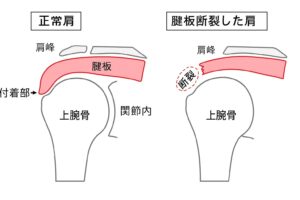 腱板損傷を図で表した状態