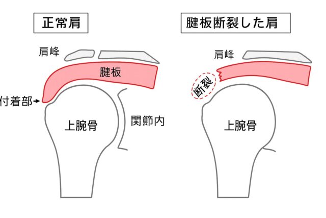 腱板損傷を図で表した状態