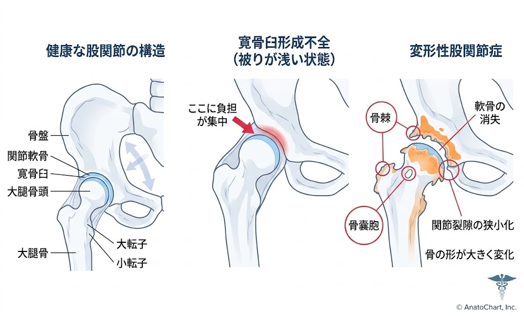 股関節の痛みから変形性股関節