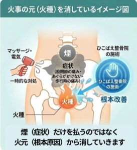 股関節の痛みの原因は股関節だけではなく、他にあるイメージ