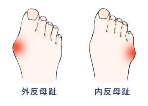 内反小趾の解説画像