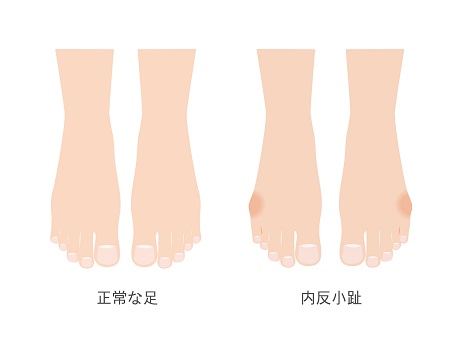 足の小指にタコができているのはなぜ 原因と対策 西宮 宝塚で根本改善の整体ならひこばえ整骨院へ