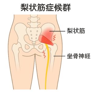 梨状筋症候群の図をイラスト