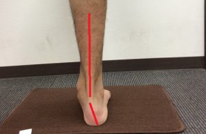 足首が歪んで捻じれる事で重心がずれている写真