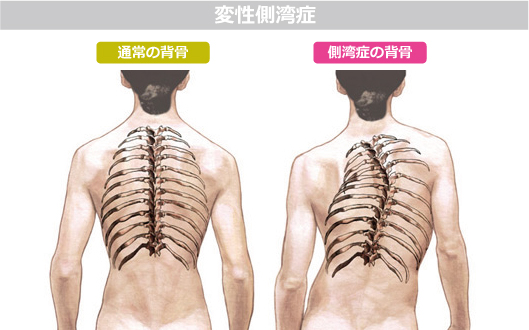 側弯症とは何ですか?