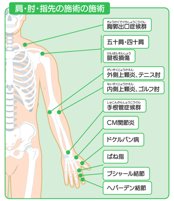 ひこばえ整骨院対応症状肩、肘