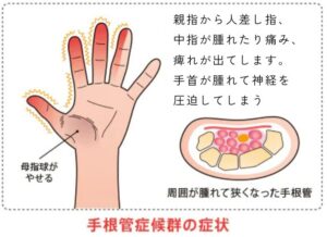 手根管症候群を示した図