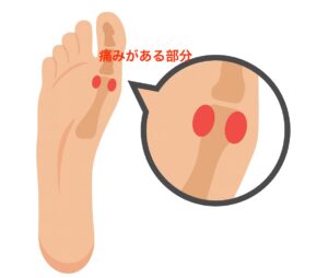 種子骨炎で痛みが強く出てくるところ