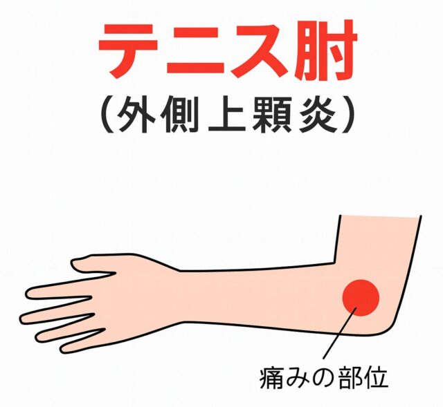 テニス肘の痛み部分
