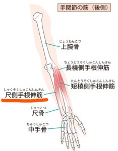 テニス肘で腕の筋肉が指についていると言う図