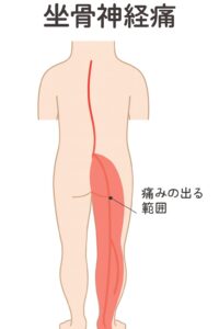 坐骨神経痛のしびれの部分